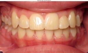 west chester orthodontics