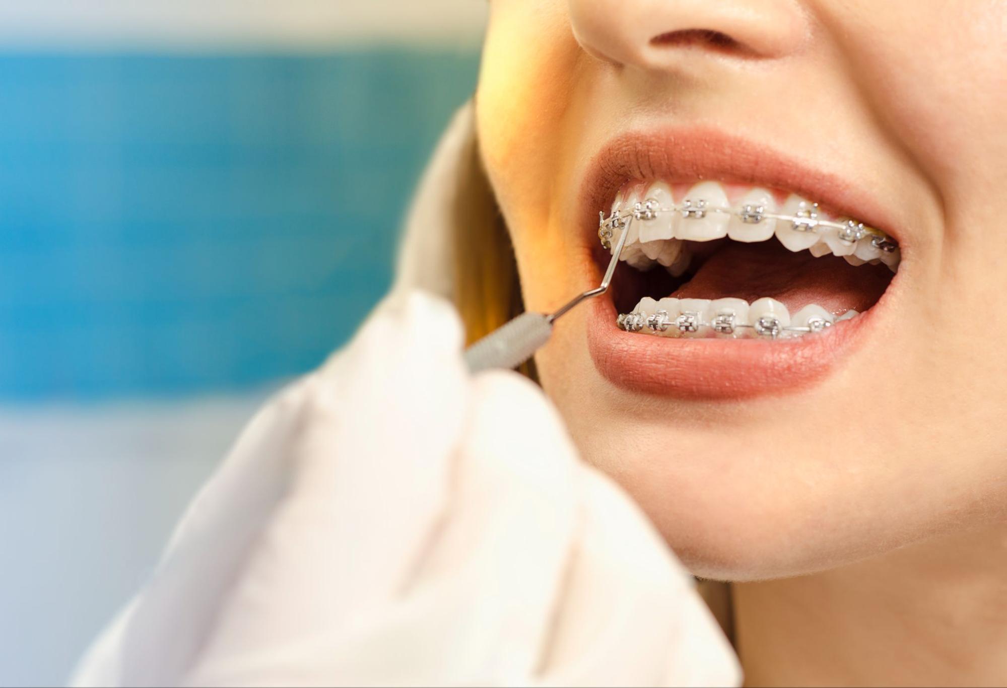 Why Staying on Schedule with Orthodontic Appointments Matters